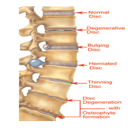 Lumbar – Welcome to Official Website of Dr.Shankar Acharya