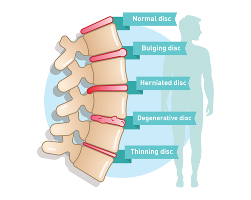 DEGENRATIVE SPINE CONDITIONS