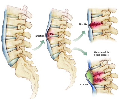 INFECTIOUS SPINE CONDITIONS